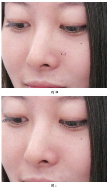 使用Photoshop CS6去除自拍照脸上的小痘痘